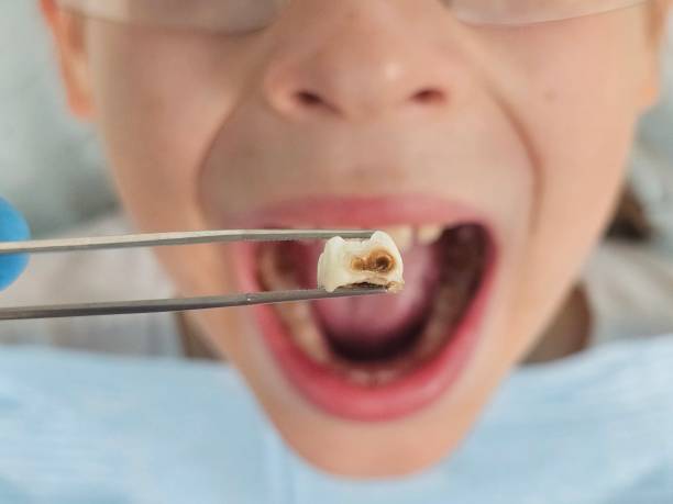 Teeth Whitening in CT